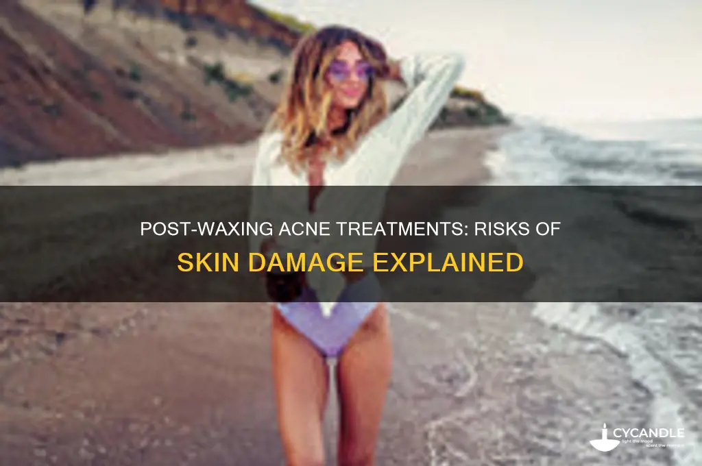 can acne treatment damage yoir skin after waxing