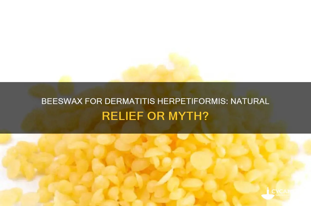 can bees wax help dermatitis herpetiformis