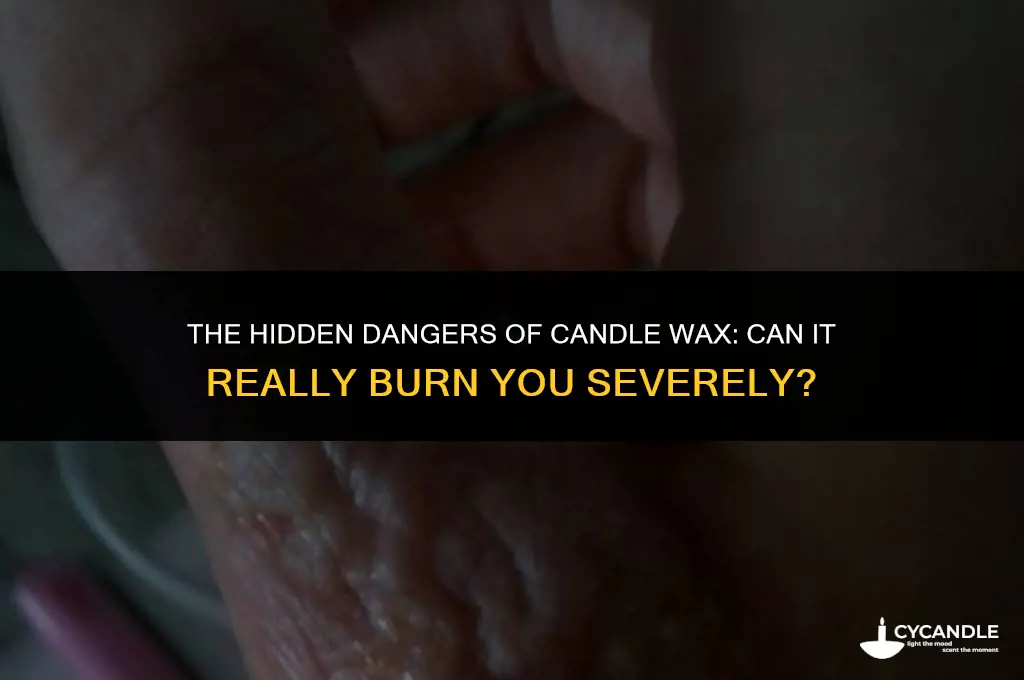 can candle wax severely burn you