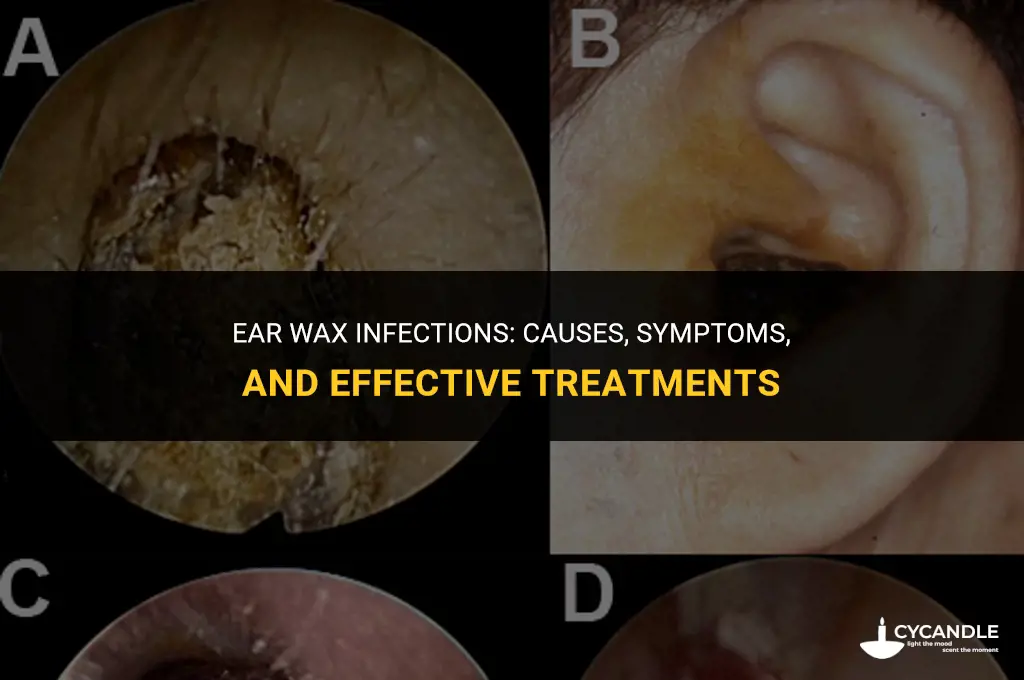 can ear wax get infected