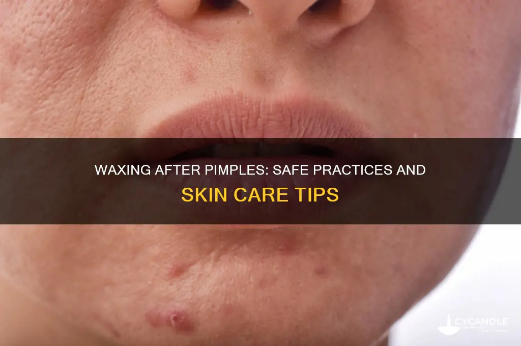 can i get a wax after pimples