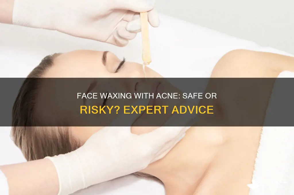 can i get my face waxed if i have acne