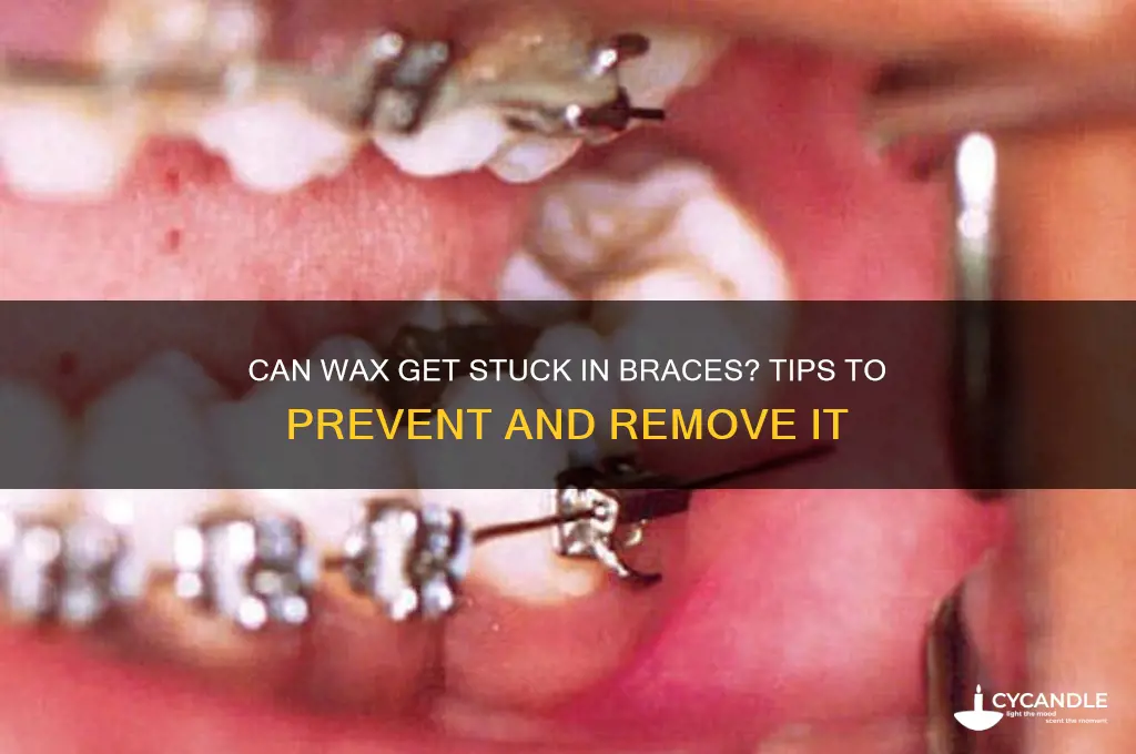 can wax get stuck in your braces