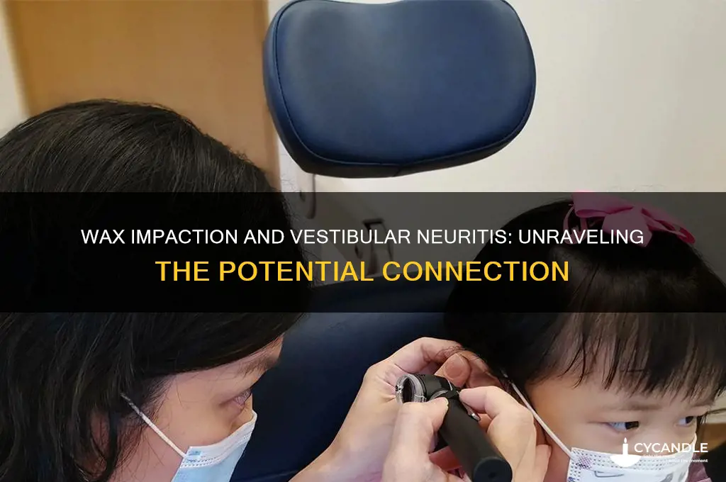 can wax impaction cause vestibular neuritis