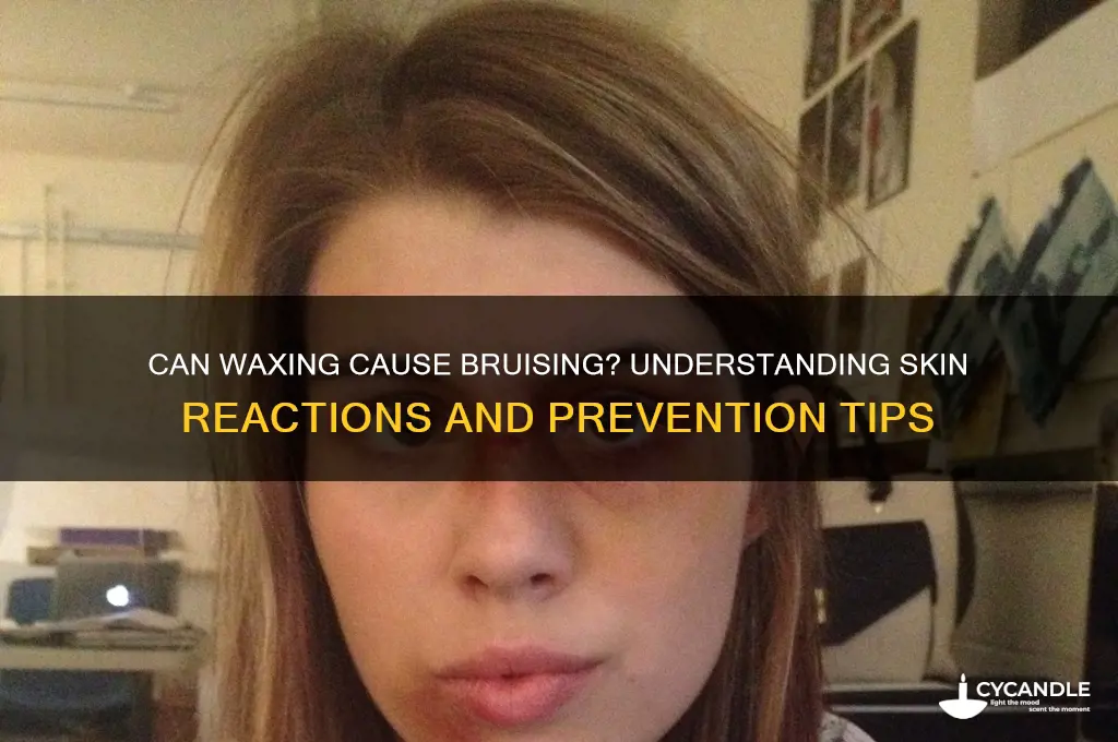 can waxing bruise you