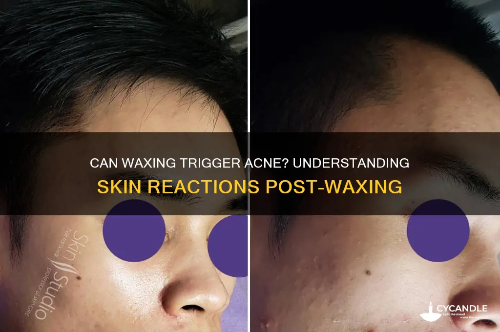can waxing cause acne