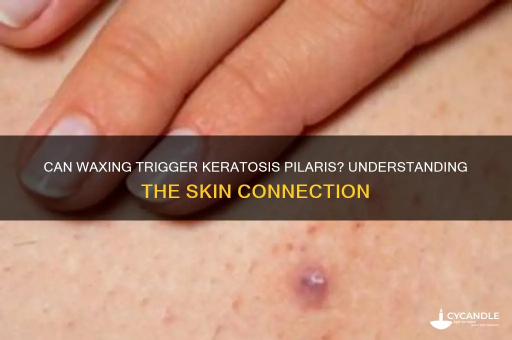 can waxing cause keratosis pilaris
