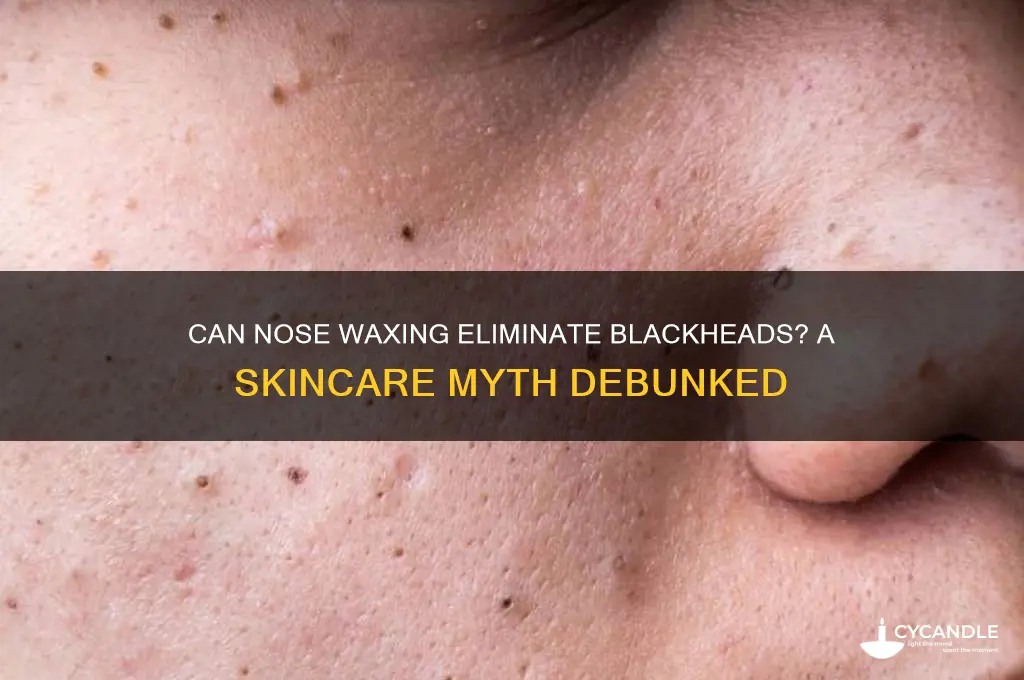can waxing your nose remove blackheads
