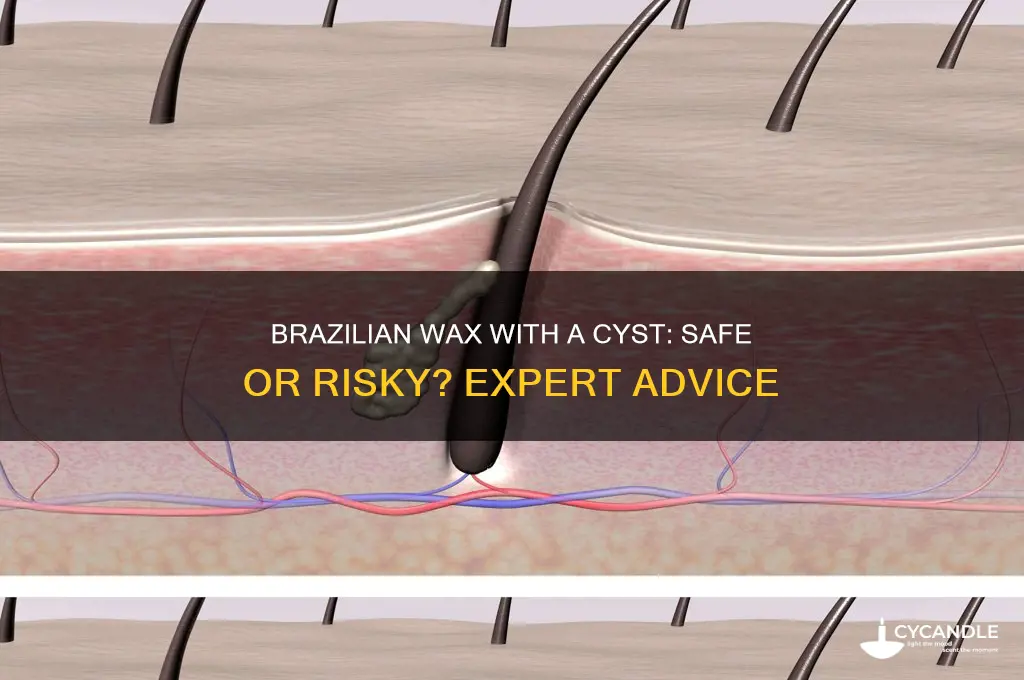 can you get a brazilian wax with a cyst