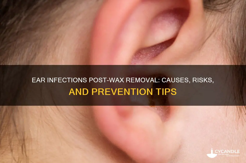 can you get an ear infection after removing wax