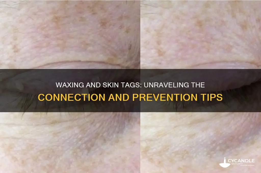 can you get skin tags from waxing