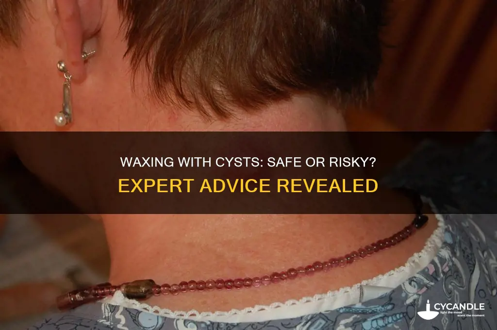 can you get waxed if you have a cyst