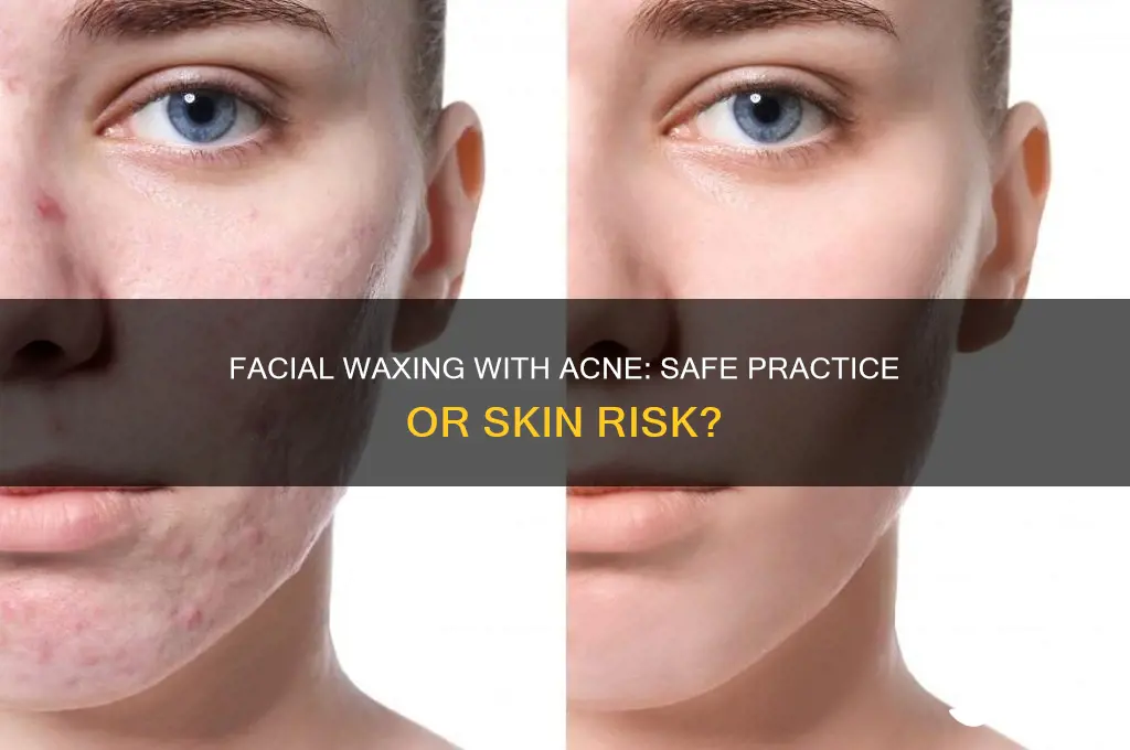 can you get your face waxed if you have acne