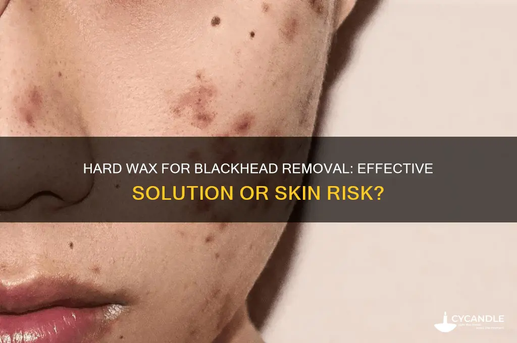 can you use hard wax to remove blackheads