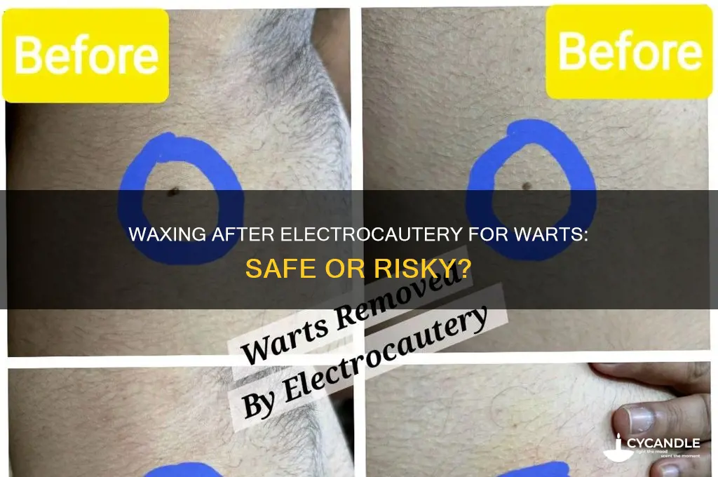 can you wax after electrocautery for warts