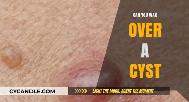 Waxing Over Cysts: Safe Practice or Risky Beauty Move?