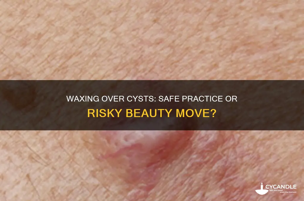 can you wax over a cyst