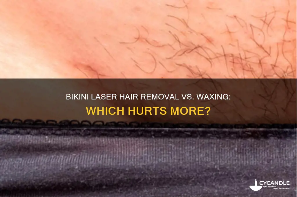 does bikini laser hair removal hurt more than waxing