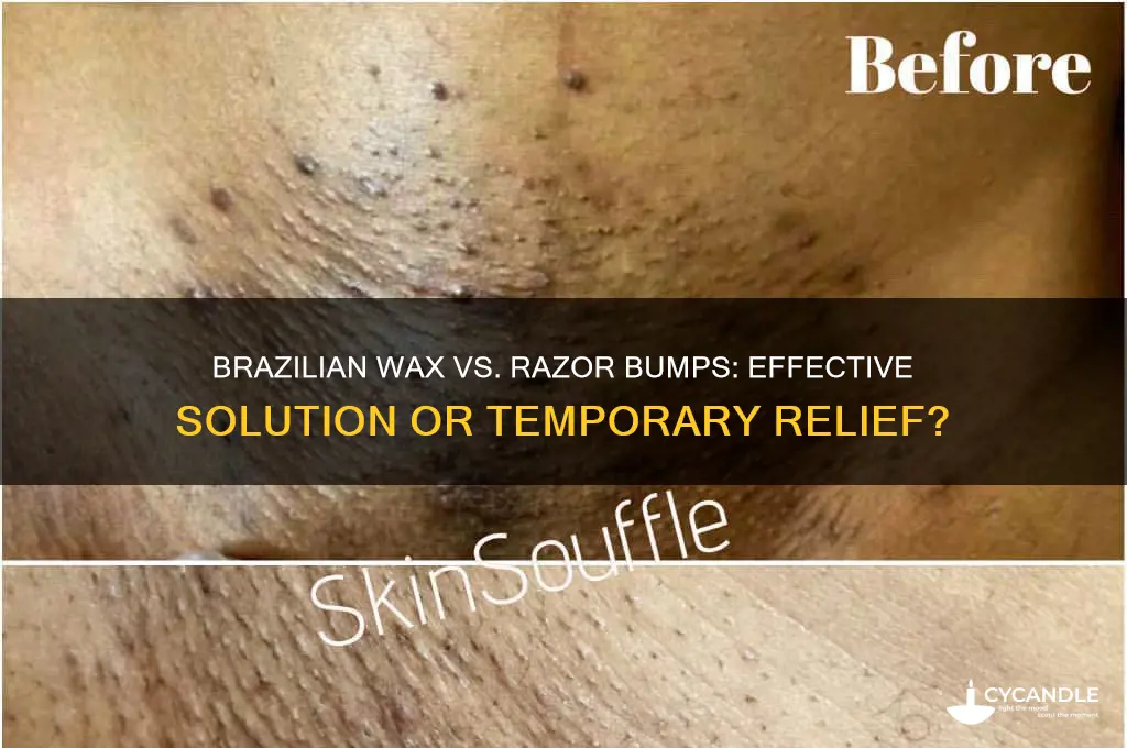 does brazilian wax remove razor bumps