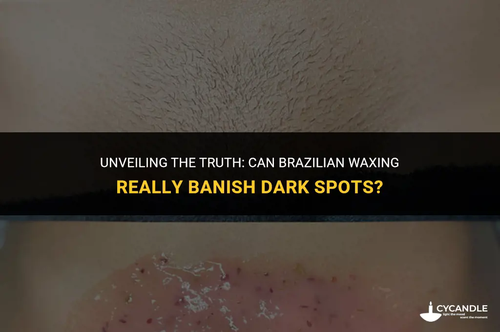 does brazilian waxing get rid of dark spots