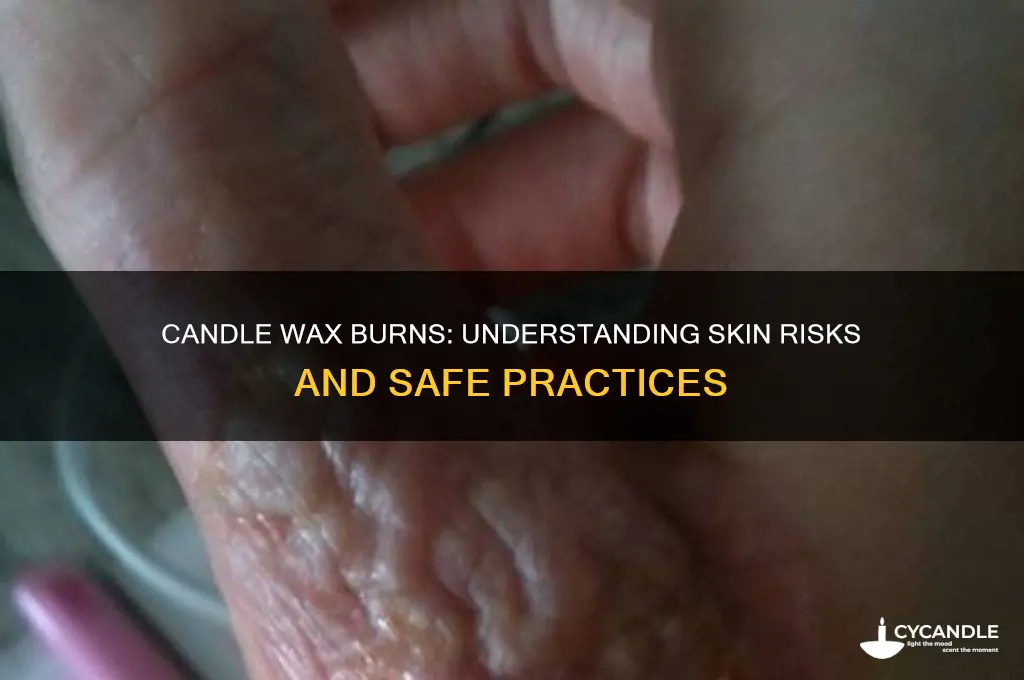 does candle wax burn your skin