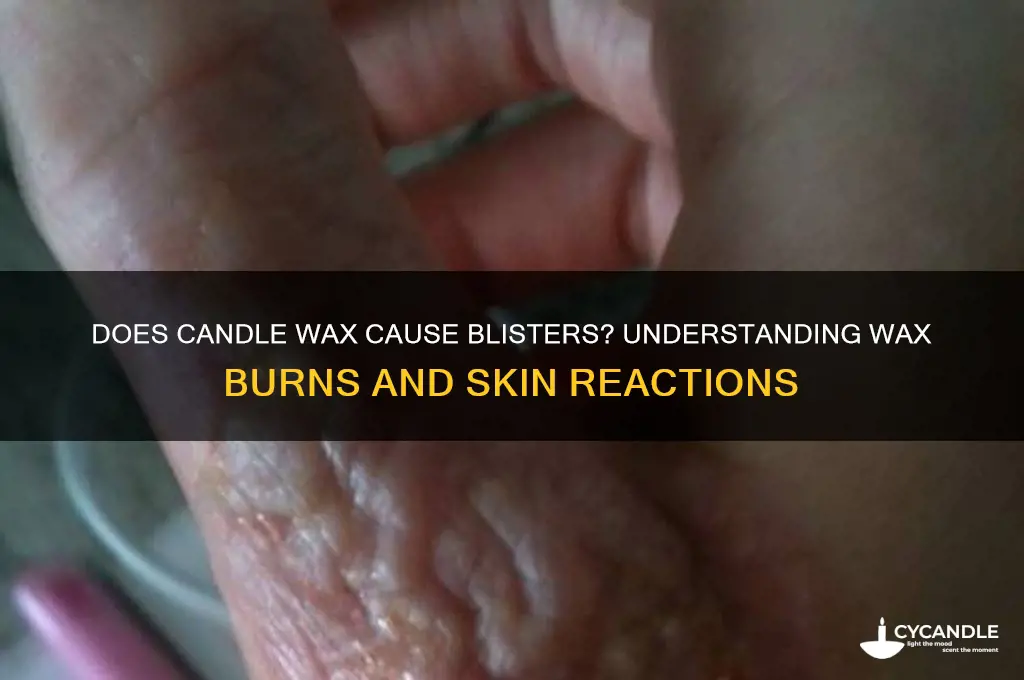 does candle wax leave blisters