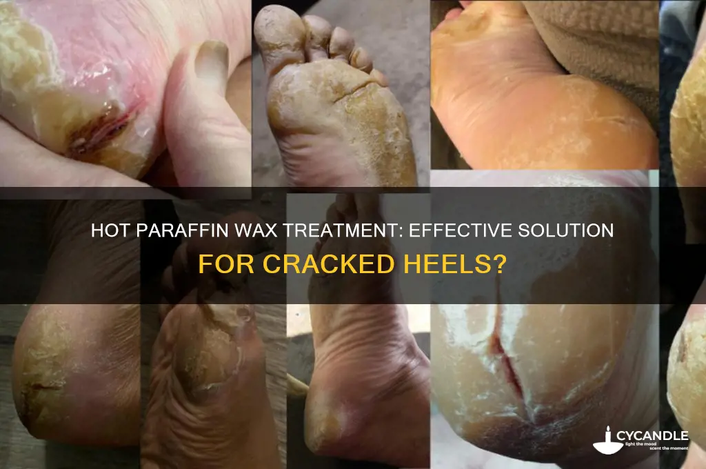 does hot paraffin wax help cracked heels