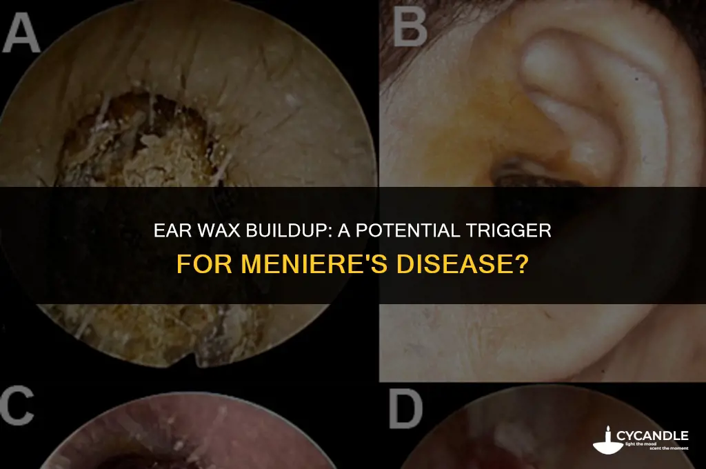 does wax in ears cause menieres