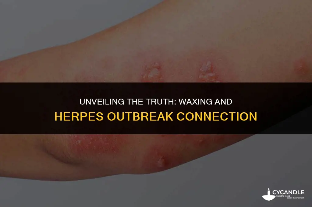 does waxing cause herpes outbreaks