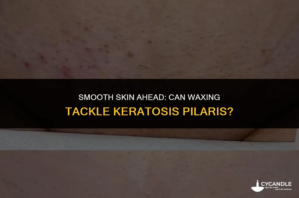 does waxing get rid of keratosis pilaris