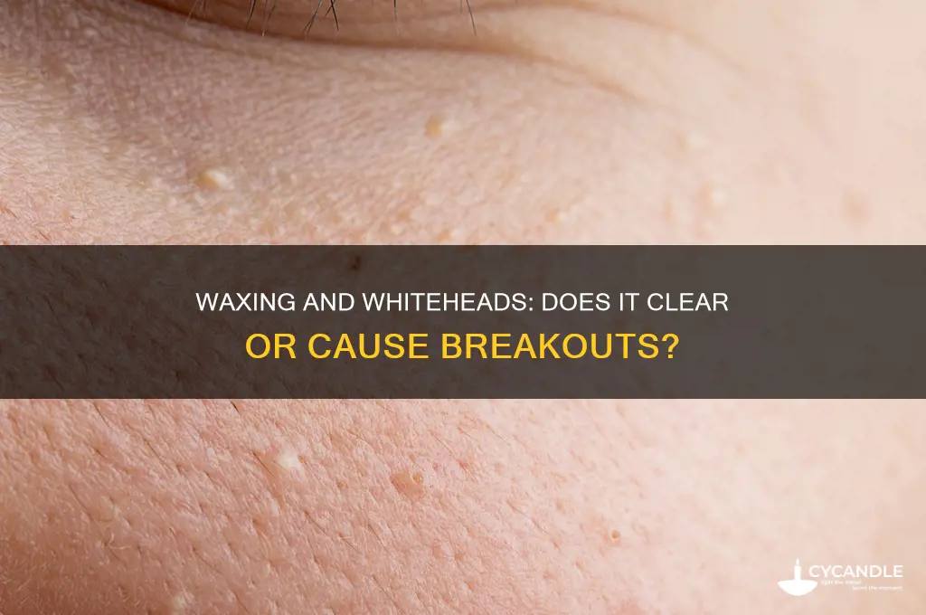does waxing remove whiteheads