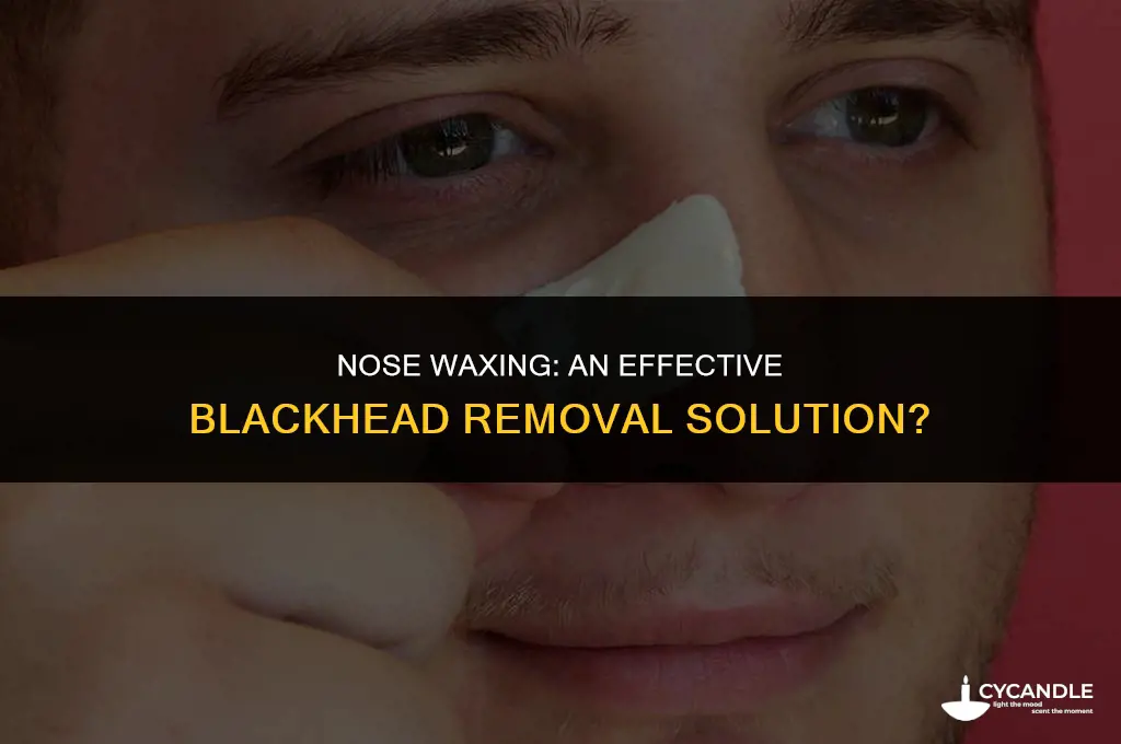 does waxing your nose get rid of blackheads