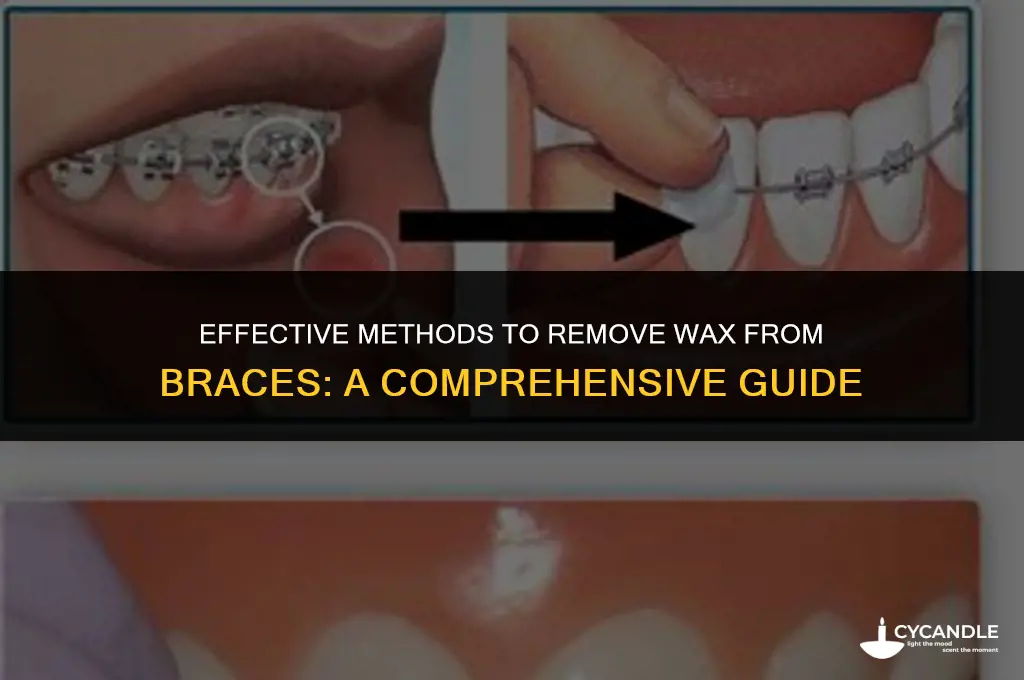 how do you get wax off of braces