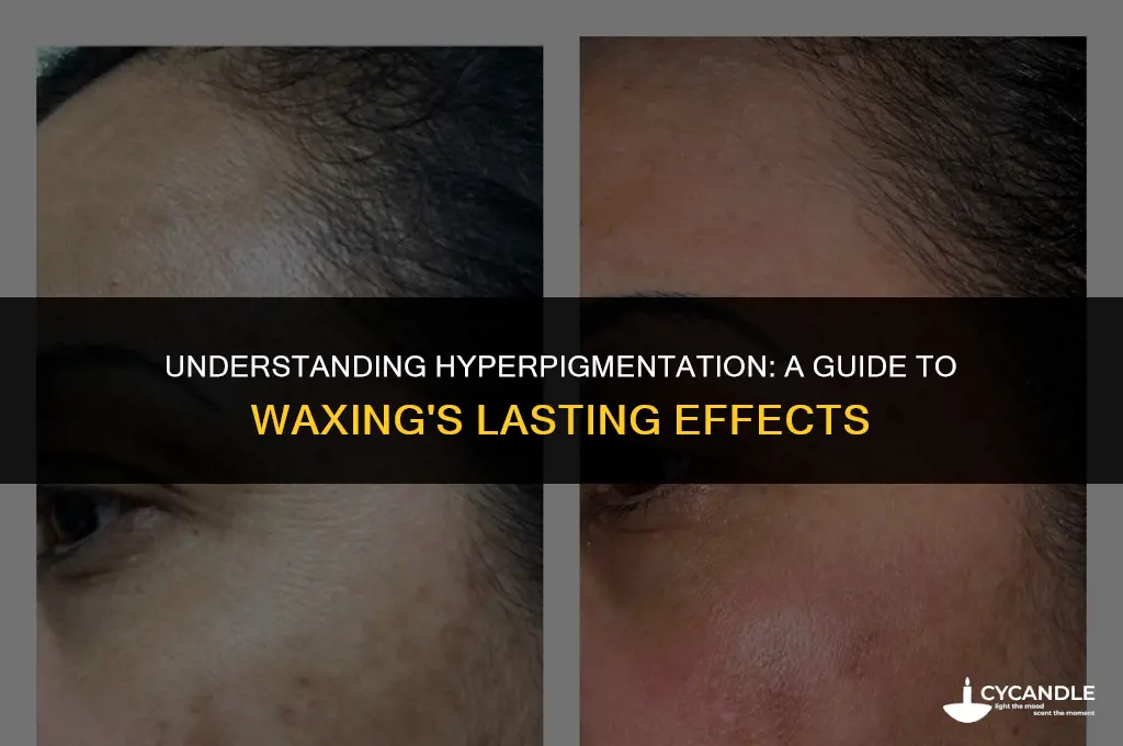 how long does hyperpigmentation from waxing last