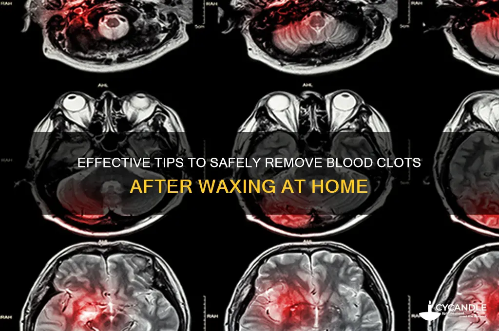 how to remove blood clot after waxing