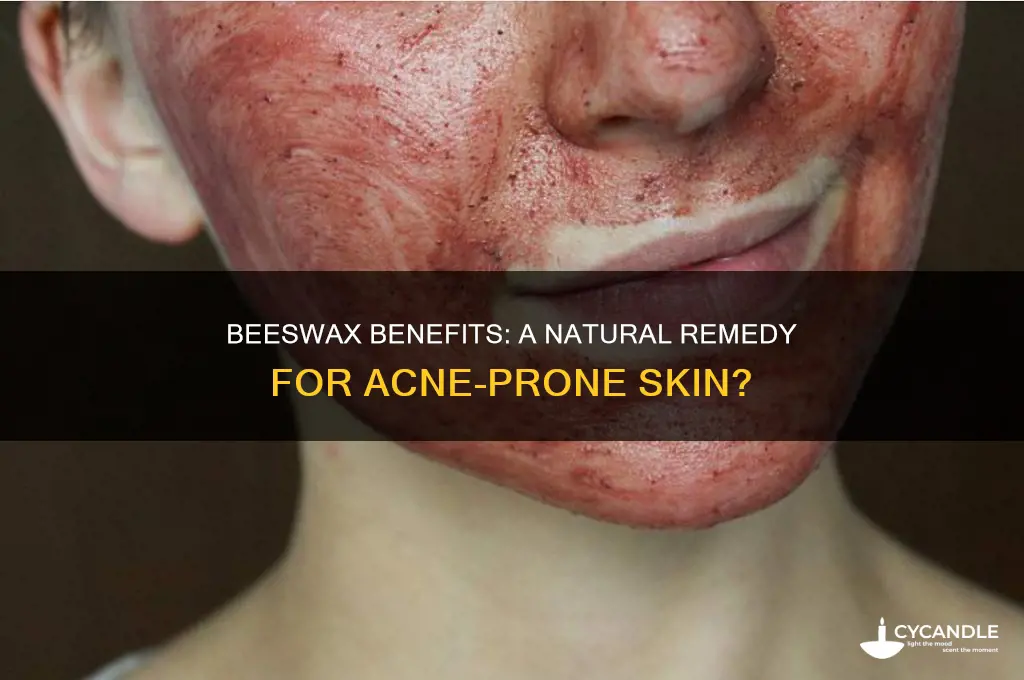 is beeswax good for acne prone skin