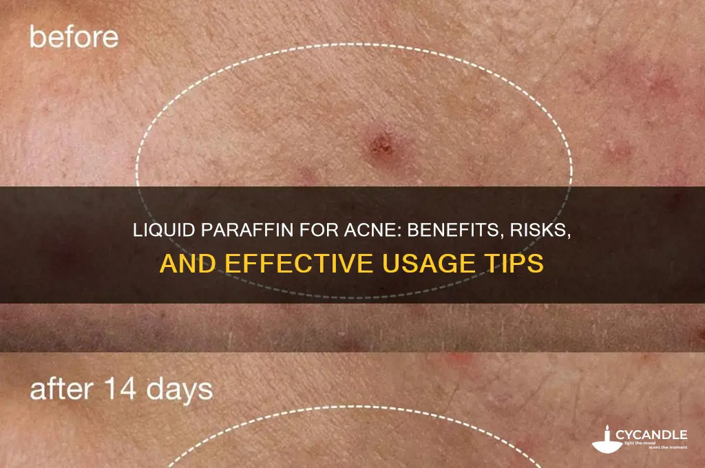 is liquid paraffin good for acne