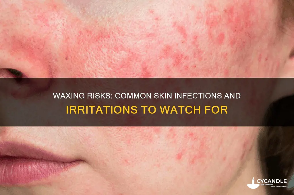 what can you catch from waxing