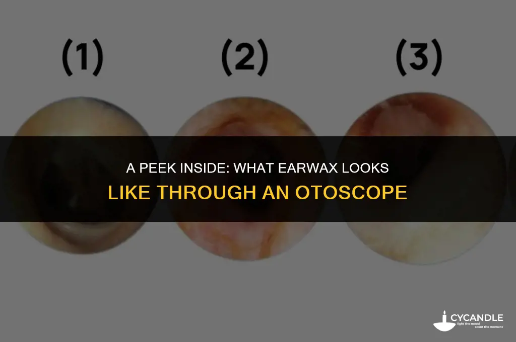 what does ear wax look like through an otoscope