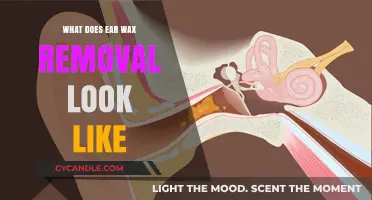 Exploring Ear Wax Removal: A Visual Guide to the Process