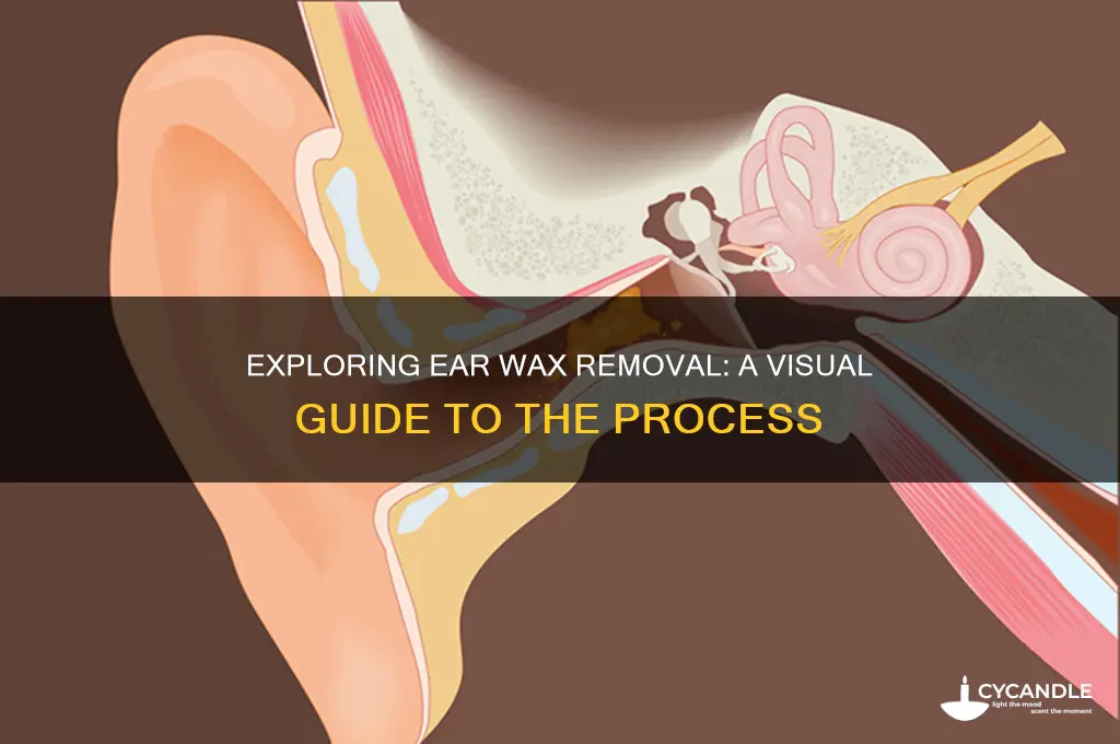 what does ear wax removal look like