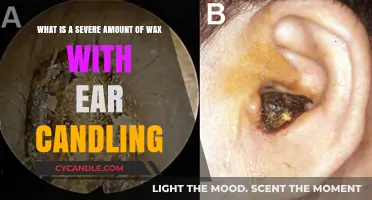 Ear Candling Risks: Severe Wax Buildup and Potential Dangers
