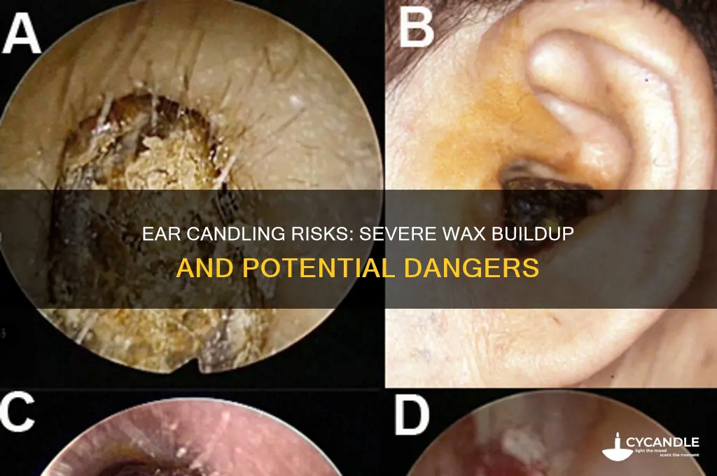 what is a severe amount of wax with ear candling