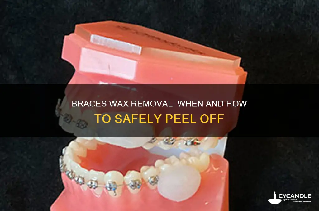 when to remove wax from braces