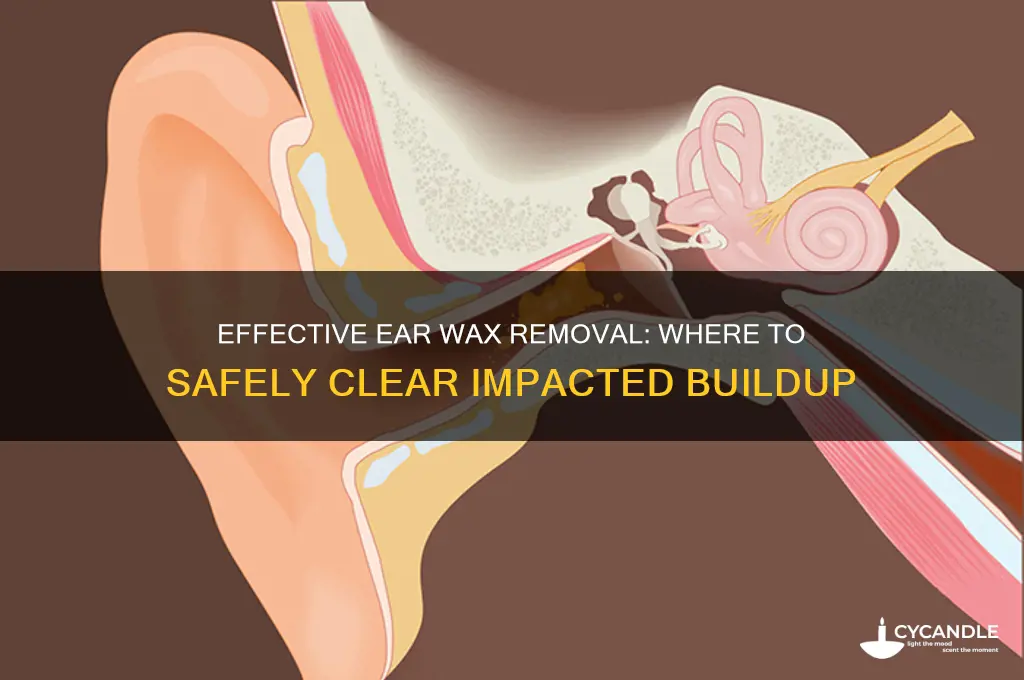 where to get impacted ear wax removed