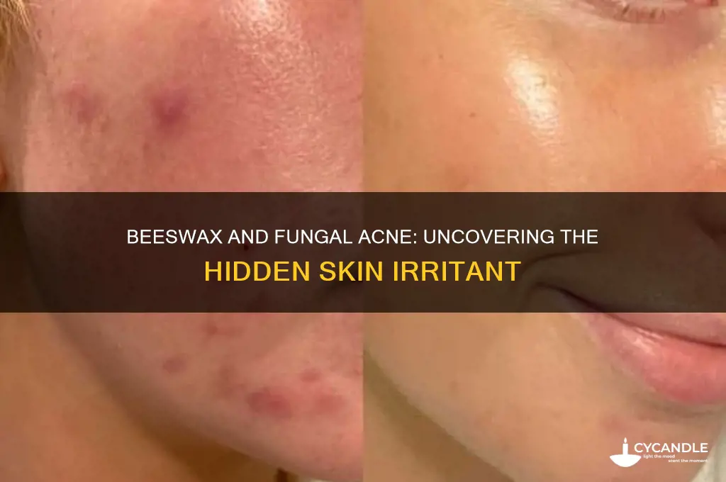 why is beeswax bad for fungal acne