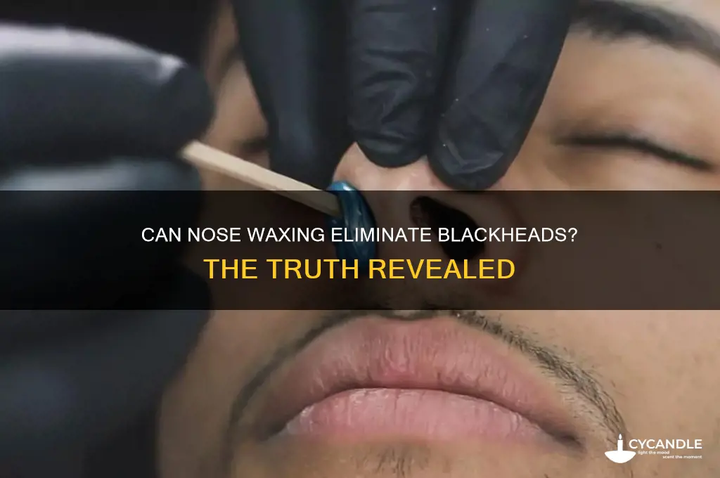 will waxing my nose remove blackheads