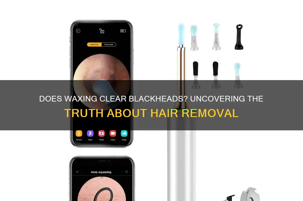 will waxing remove blackheads